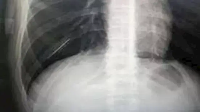 أطباء روس ينقذون حياة مراهق وي...