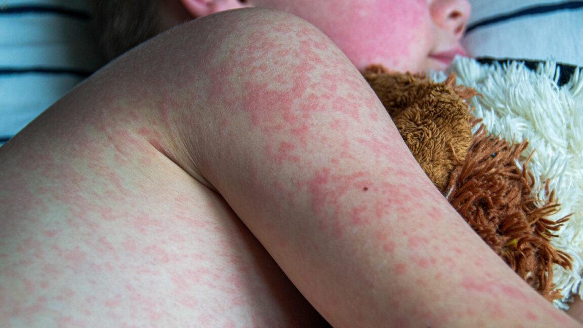 Two unvaccinated people die fr...