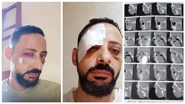 استغاثة مواطن بالغربية بوزير الداخلية بعد الاعتداء عليه: "ركبت شرايح ومسامير"