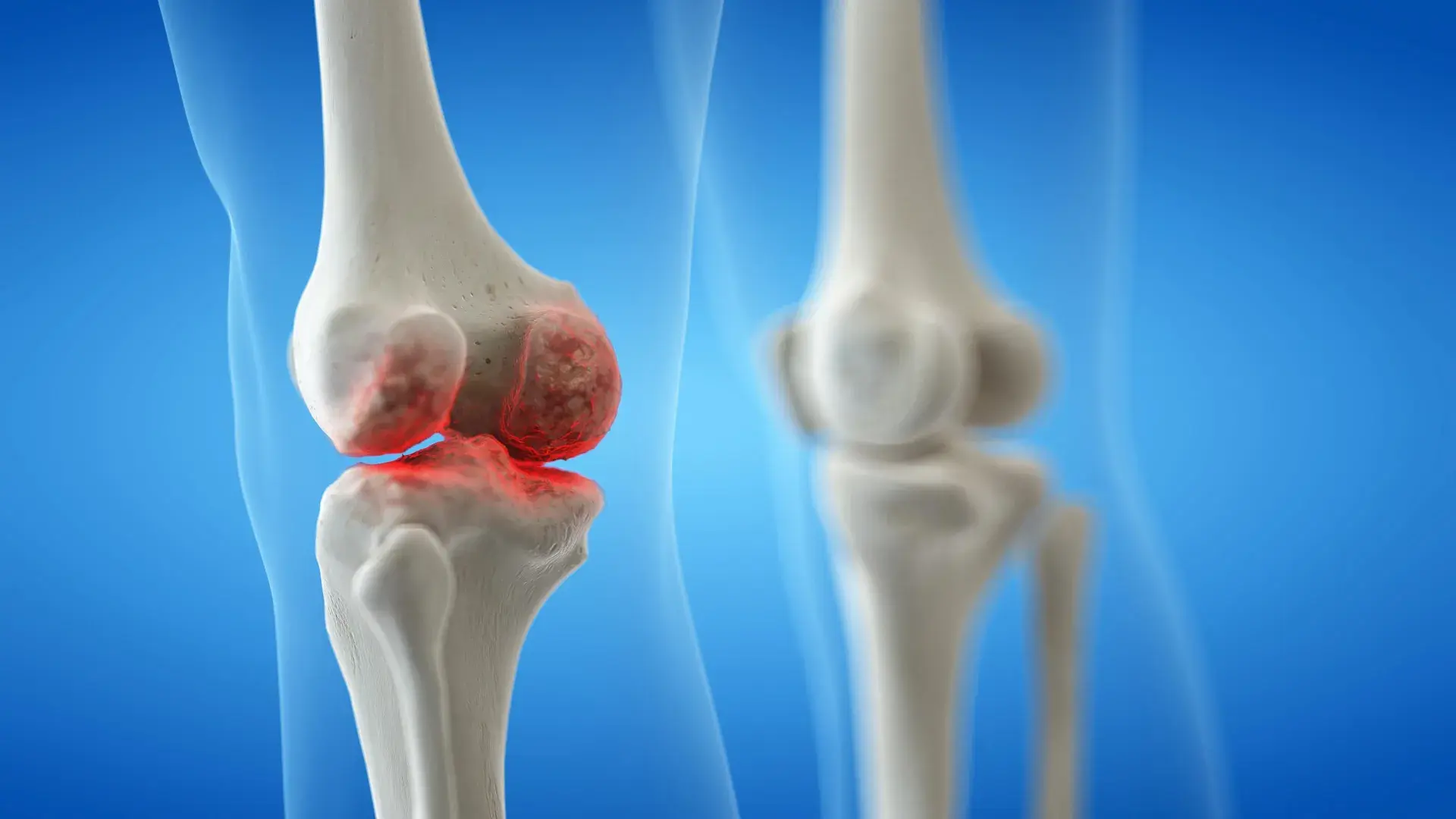 Knee osteoarthritis isn’t inev...