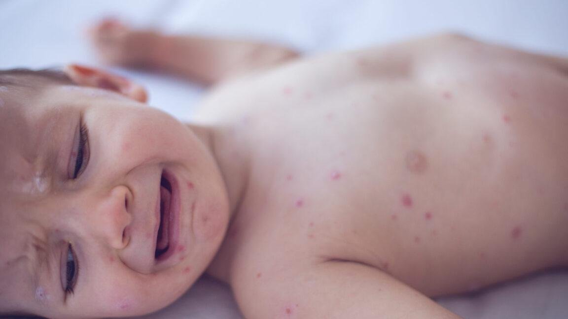 Measles killed 6-week-old baby...