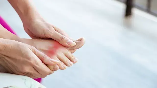 النقرس.. ما أسبابه ومن الفئات...