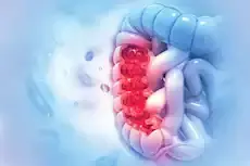 4 أعراض قد تكشف سرطان القولون...