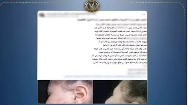 مدرسة تضرب طفلة بالوجه والبطن وتبرر فعلتها بإصابتها بفرط الحركة بالإسكندرية